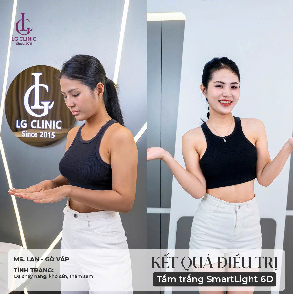 tắm trắng tại lg